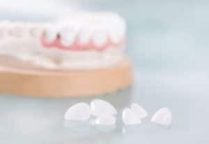 Cosmetic-Dentistry-Porcelain-Veneers-Dentist-Orem-Utah