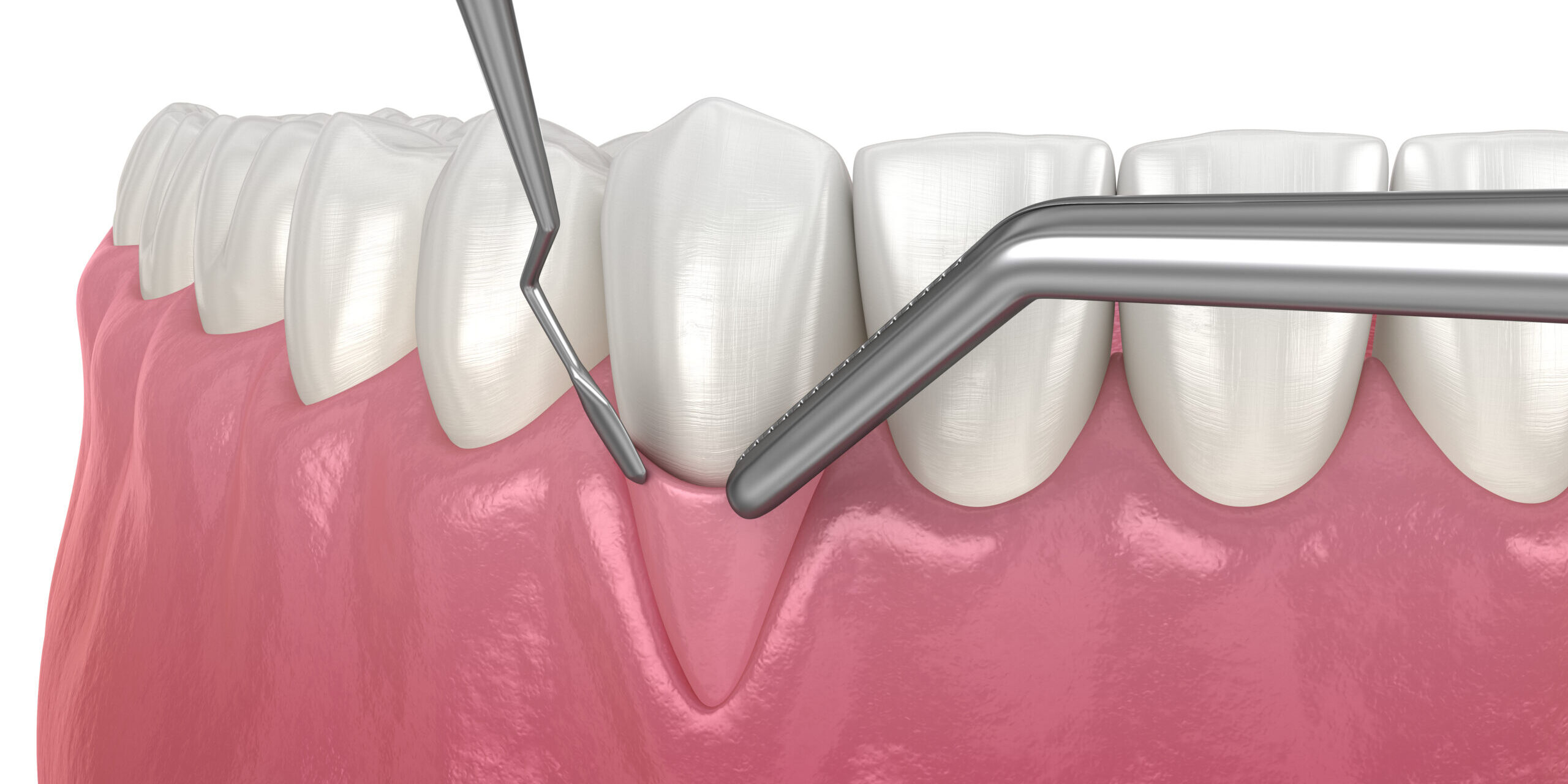Gum Recession in Orem Crawford Leishman Dental Vineyard, UT 84059